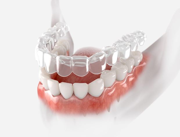 Clear aligners at DentoWorld Ahmedabad