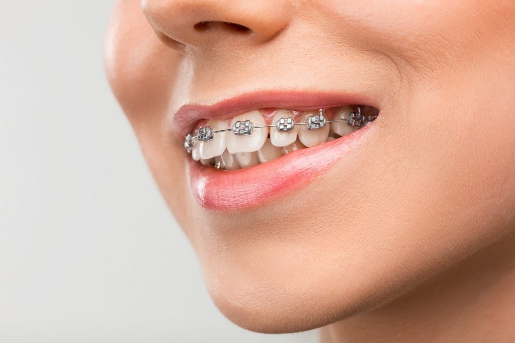 Braces treatment at DentoWorld Ahmedabad
